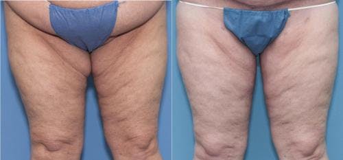 Thigh Lift Before & After Gallery - Patient 58172373 - Image 1