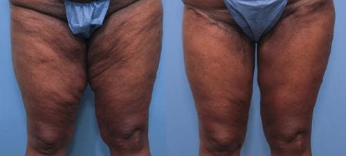 Thigh Lift Before & After Gallery - Patient 58172377 - Image 1
