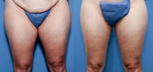 Thighs Before & After Gallery - Patient 149385417 - Image 1