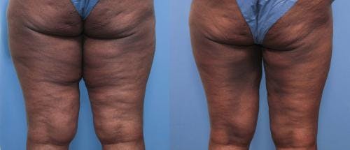 Thigh Lift Before & After Gallery - Patient 58172377 - Image 2