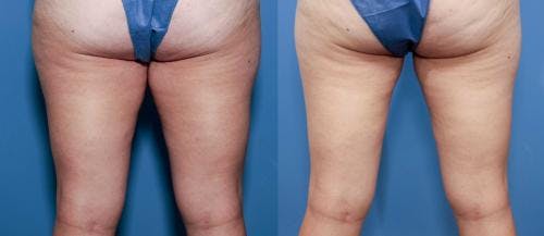 Thighs Before & After Gallery - Patient 149385417 - Image 2