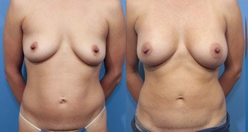 Mommy Makeover Before & After Gallery - Patient 58172378 - Image 1