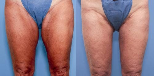 Thigh Lift Before & After Gallery - Patient 58172380 - Image 1