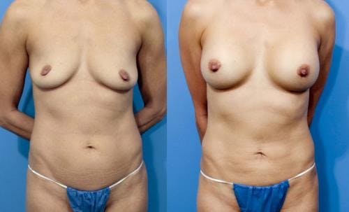 Mommy Makeover Before & After Gallery - Patient 58172384 - Image 1