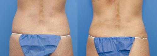 Abdomen Before & After Gallery - Patient 149385219 - Image 2
