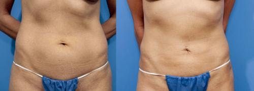Abdomen Before & After Gallery - Patient 149385219 - Image 1