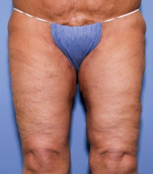 Thigh Lift Before & After Gallery - Patient 58172386 - Image 2