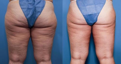Thighs Before & After Gallery - Patient 149385409 - Image 1