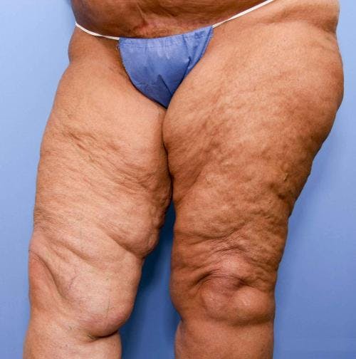 Thigh Lift Before & After Gallery - Patient 58172386 - Image 3