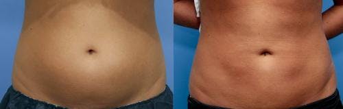 Abdomen Before & After Gallery - Patient 149385221 - Image 1