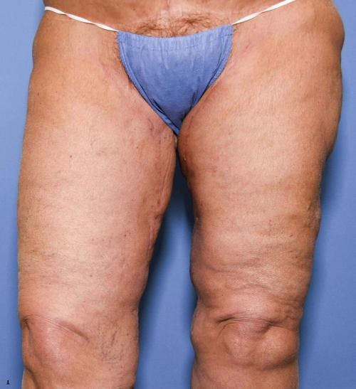 Thigh Lift Before & After Gallery - Patient 58172386 - Image 4