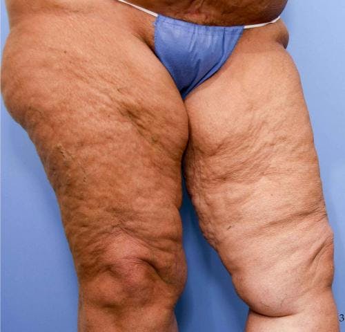 Thigh Lift Before & After Gallery - Patient 58172386 - Image 5