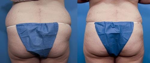 Hips Before & After Gallery - Patient 149385334 - Image 1