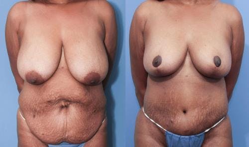 Mommy Makeover Before & After Gallery - Patient 58172387 - Image 1