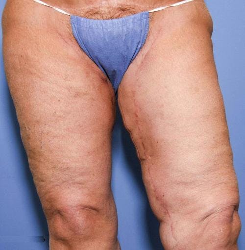 Thigh Lift Before & After Gallery - Patient 58172386 - Image 6