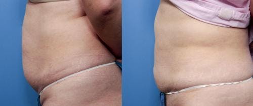 Abdomen Before & After Gallery - Patient 149385220 - Image 2
