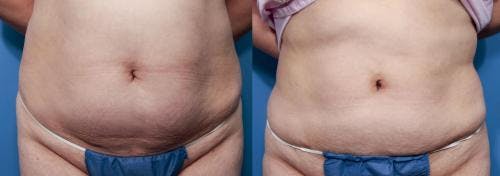 Abdomen Before & After Gallery - Patient 149385220 - Image 1