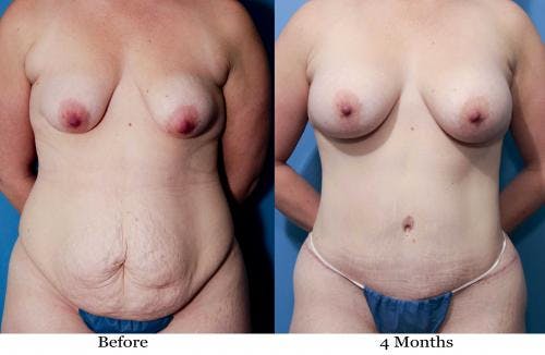 Mommy Makeover Before & After Gallery - Patient 58172389 - Image 1