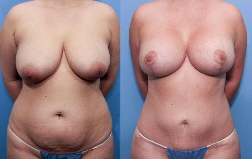 Mommy Makeover Before & After Gallery - Patient 58172390 - Image 1