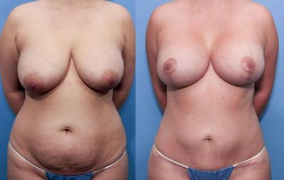 Mommy Makeover Before & After Gallery - Patient 58172390 - Image 1