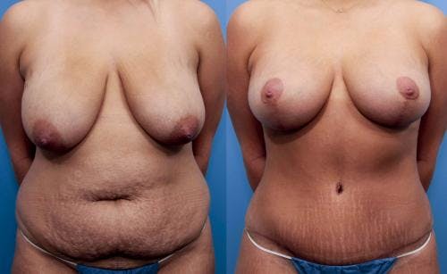 Mommy Makeover Before & After Gallery - Patient 58172391 - Image 1