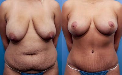 Mommy Makeover Before & After Gallery - Patient 58172391 - Image 1