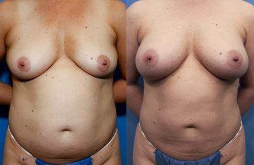 Mommy Makeover Before & After Gallery - Patient 58172392 - Image 1