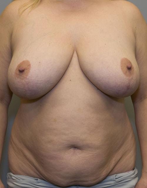 Mommy Makeover Before & After Gallery - Patient 58172393 - Image 1