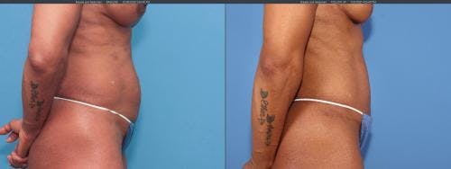 Tummy Tuck Before & After Gallery - Patient 58172396 - Image 2