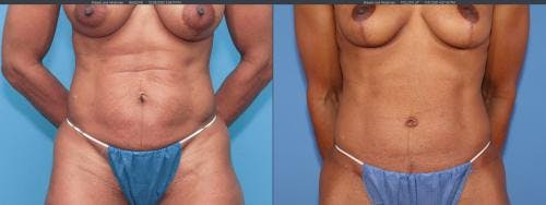 Tummy Tuck Before & After Gallery - Patient 58172396 - Image 1
