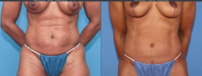 Tummy Tuck Before & After Gallery - Patient 58172396 - Image 1