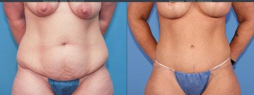 Tummy Tuck Before & After Gallery - Patient 58172398 - Image 2
