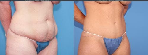 Tummy Tuck Before & After Gallery - Patient 58172398 - Image 3