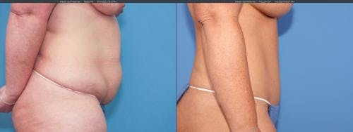 Tummy Tuck Before & After Gallery - Patient 58172398 - Image 4