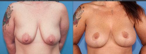 Tummy Tuck Before & After Gallery - Patient 58172398 - Image 6