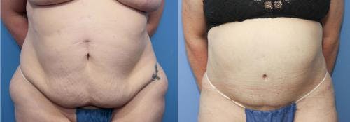 Tummy Tuck Before & After Gallery - Patient 58172400 - Image 1