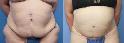 Tummy Tuck Before & After Gallery - Patient 58172400 - Image 1