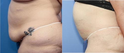 Tummy Tuck Before & After Gallery - Patient 58172400 - Image 2