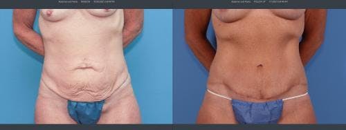 Tummy Tuck Before & After Gallery - Patient 58172401 - Image 1