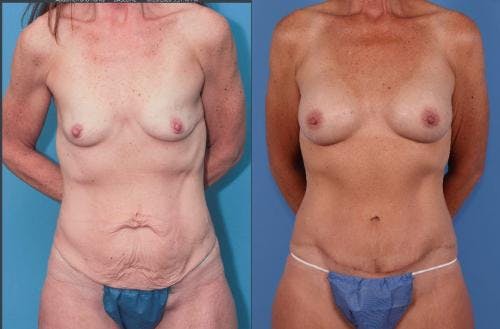 Tummy Tuck Before & After Gallery - Patient 58172401 - Image 3
