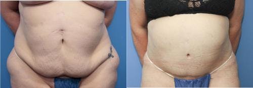 Tummy Tuck Before & After Gallery - Patient 58172403 - Image 1