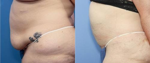 Tummy Tuck Before & After Gallery - Patient 58172403 - Image 2