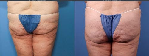 Brazilian Buttock Lift Before & After Gallery - Patient 58172402 - Image 1