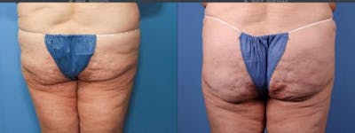 Brazilian Buttock Lift Before & After Gallery - Patient 58172402 - Image 1