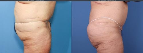 Brazilian Buttock Lift Before & After Gallery - Patient 58172402 - Image 2