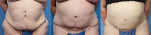 Tummy Tuck Before & After Gallery - Patient 58172403 - Image 3