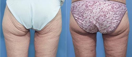 Brazilian Buttock Lift Before & After Gallery - Patient 58172404 - Image 1