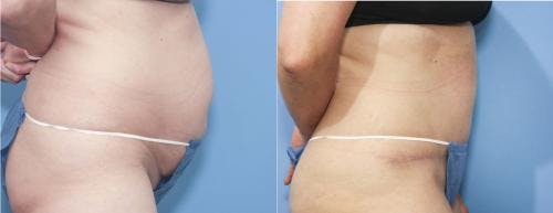 Tummy Tuck Before & After Gallery - Patient 58172405 - Image 2