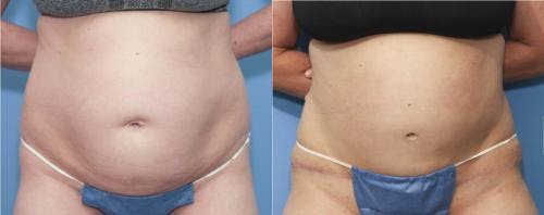 Tummy Tuck Before & After Gallery - Patient 58172405 - Image 1