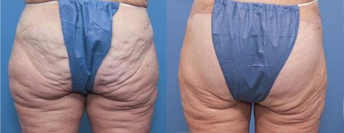 Brazilian Buttock Lift Before & After Gallery - Patient 58172406 - Image 1